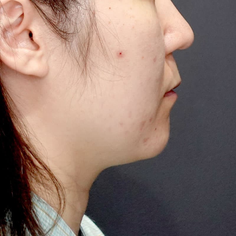20260417_G28304_morishima_face-liposuction_philtrum-botox②Before