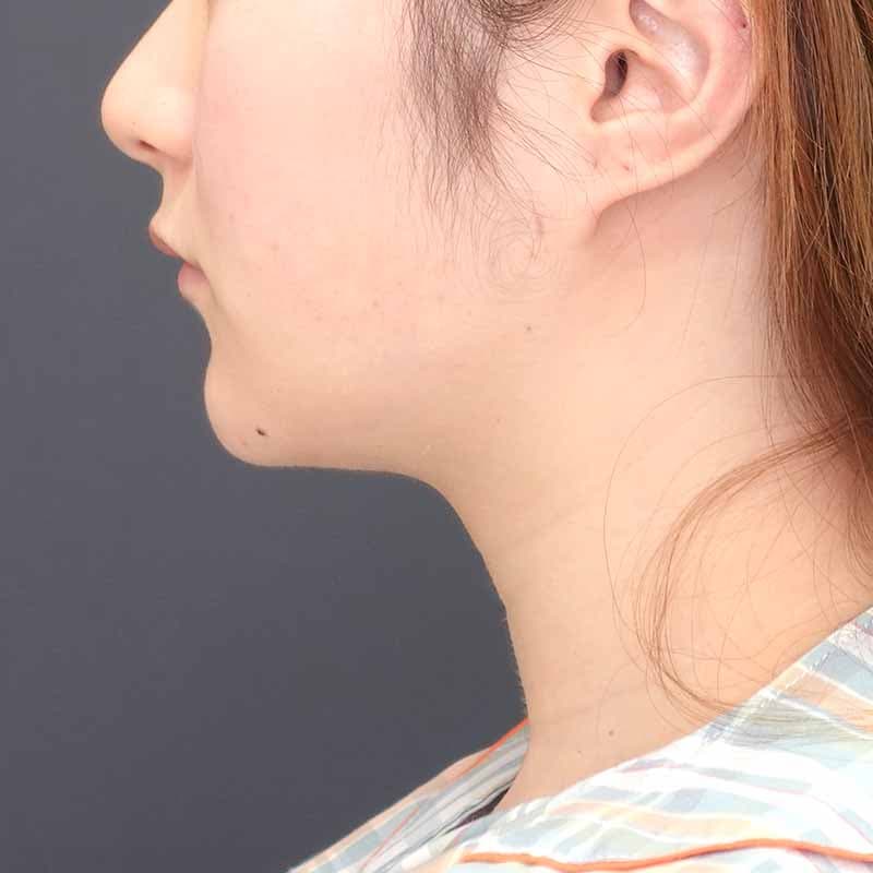 20260417_N104538_osada_face-liposuction ①After