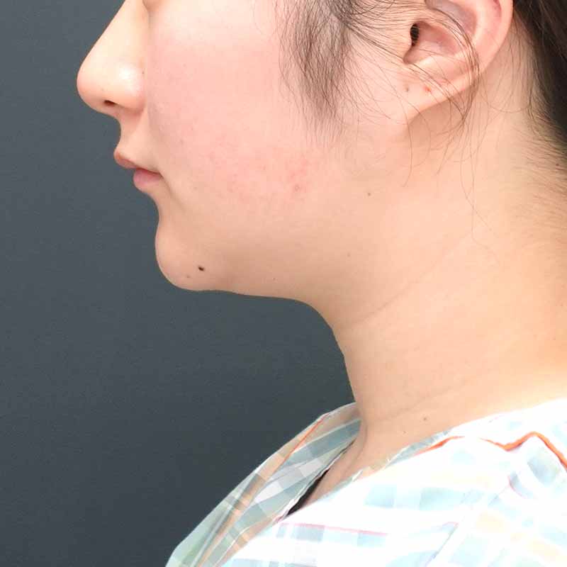 20260417_N104538_osada_face-liposuction ①Before