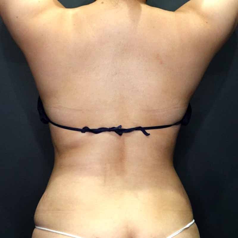 20260420_G153239_osada_stomach-liposuction①After