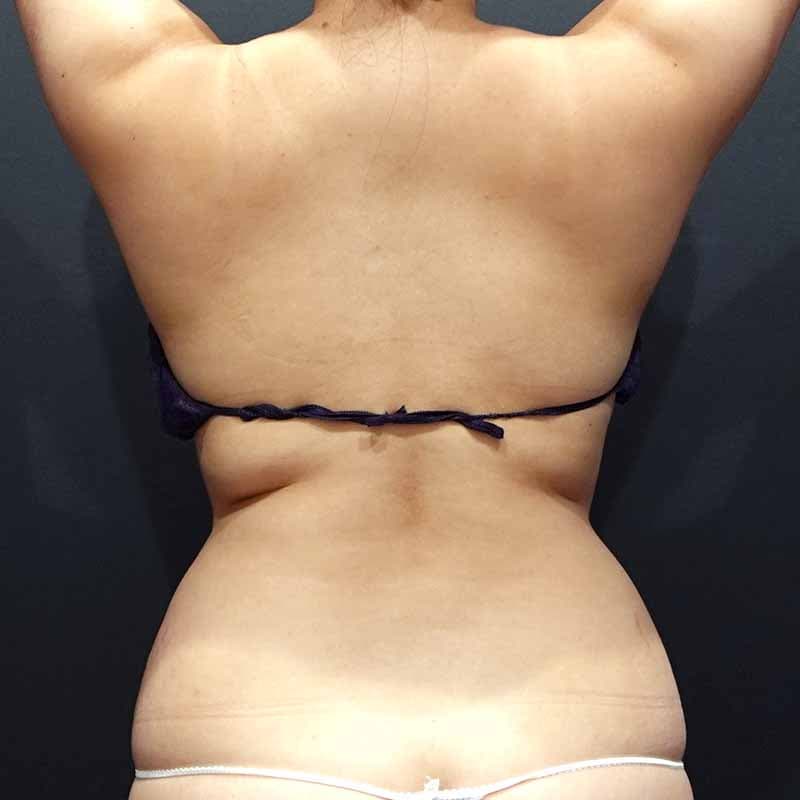 20260420_G153239_osada_stomach-liposuction①Before