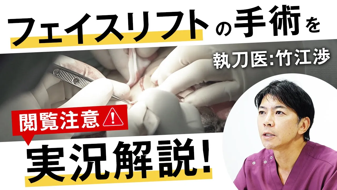 【閲覧注意】切開フェイスリフトの手術を徹底解説｜SMAS法・剥離・縫合まで完全公開