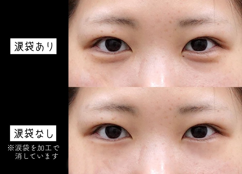 涙袋の必要性②