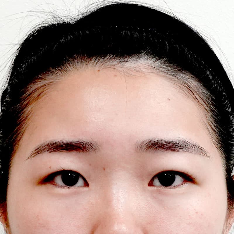 20251011_G10168_tokiwa_hyaluronic forehead①After
