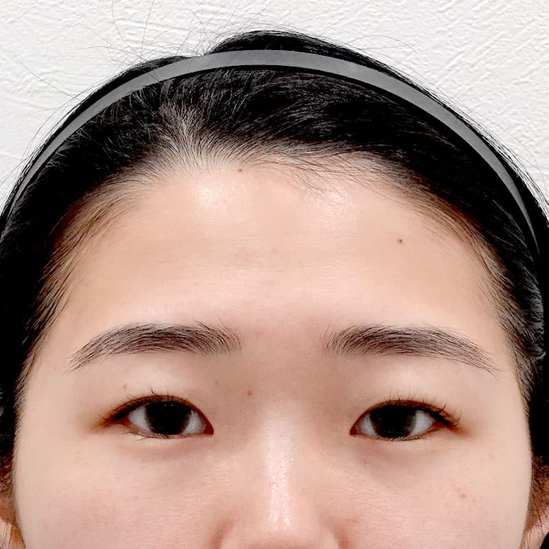 20251011_G10168_tokiwa_hyaluronic forehead①Before