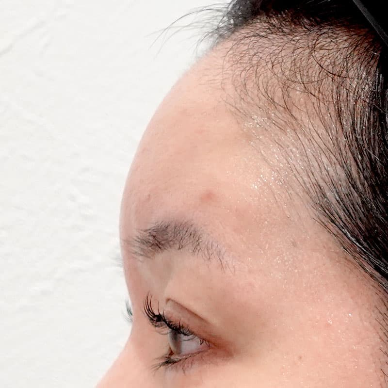 20260111_G127906_ota_hyaluronic forehead①After