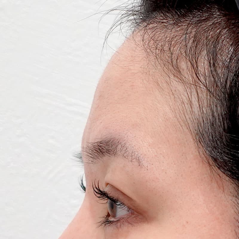 20260111_G127906_ota_hyaluronic forehead①Before