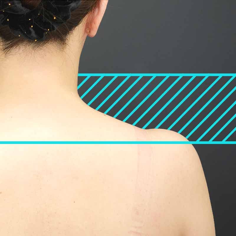 202605012_st202605012-1_sakai_shoulder-botoxの①Before