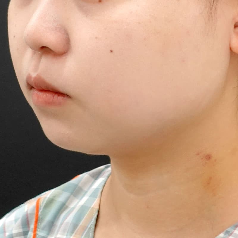 20260506_F1093_kaneko_face-liposuction_masseter-muscle-botox①Before