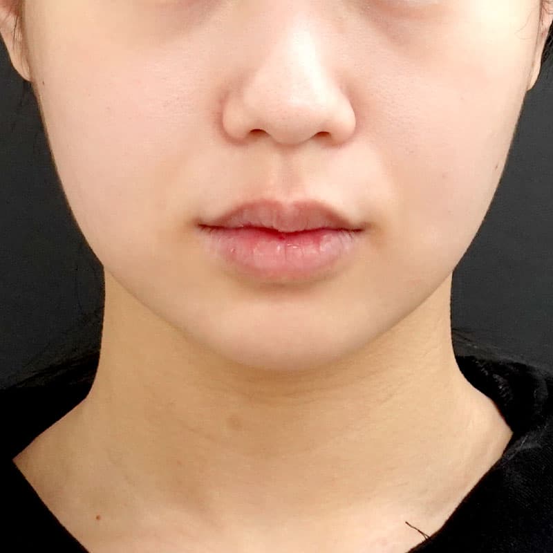 20260506_F3329_kaneko_face-liposuction_masseter-muscle-botox①After