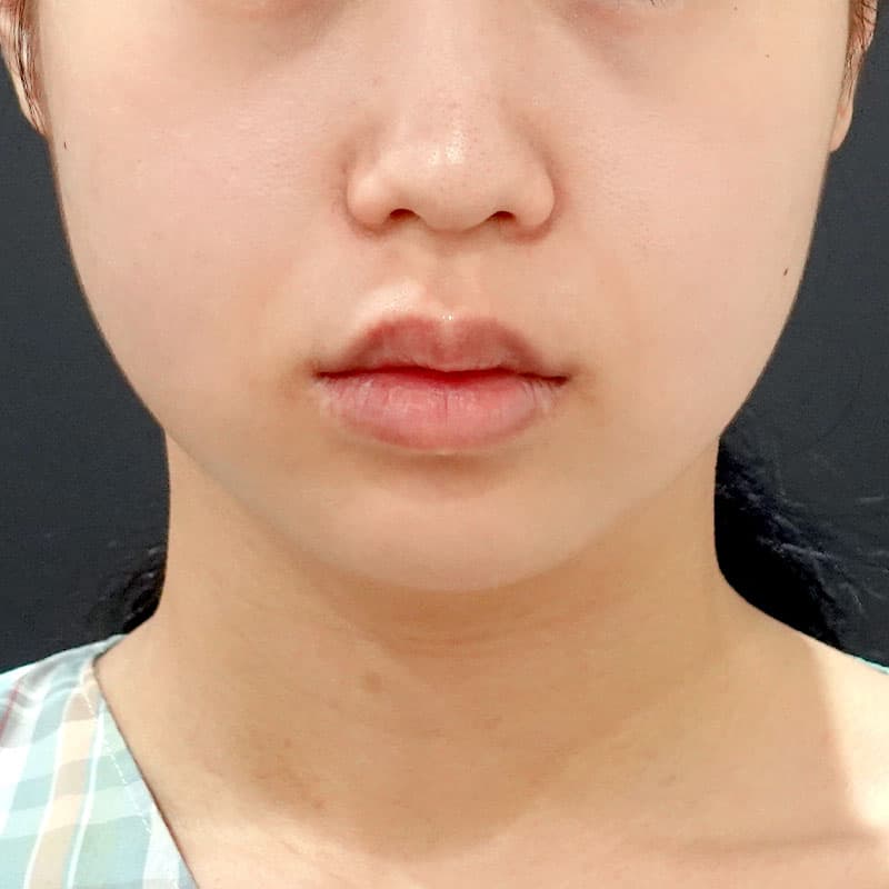 20260506_F3329_kaneko_face-liposuction_masseter-muscle-botox①Before