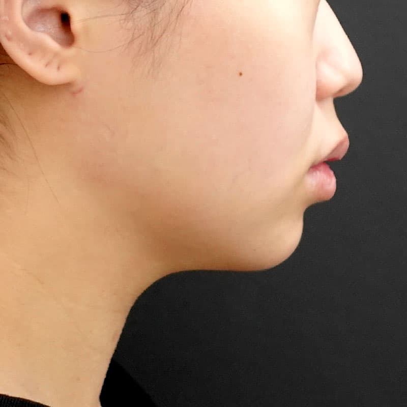 20260506_F3329_kaneko_face-liposuction_masseter-muscle-botox②After