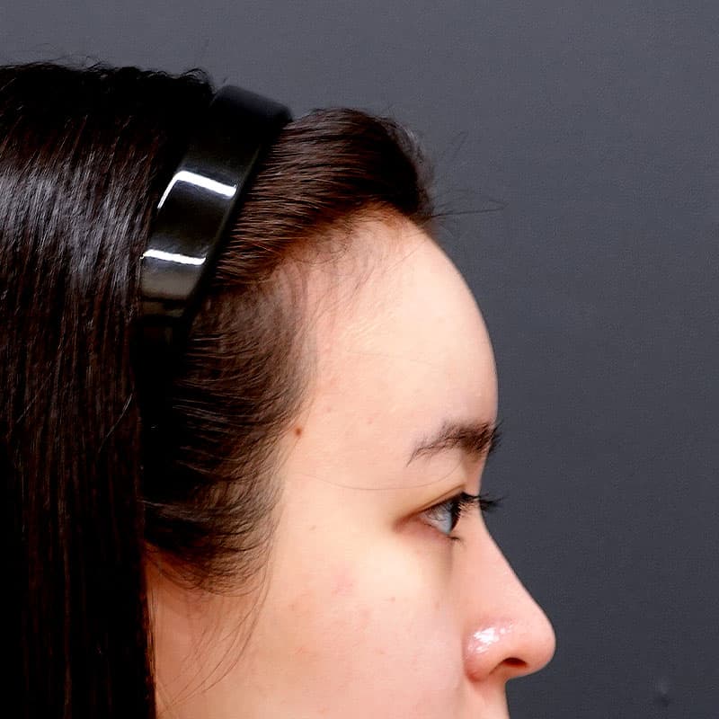 20260506_O33755_sugishima_hyaluronic forehead①After