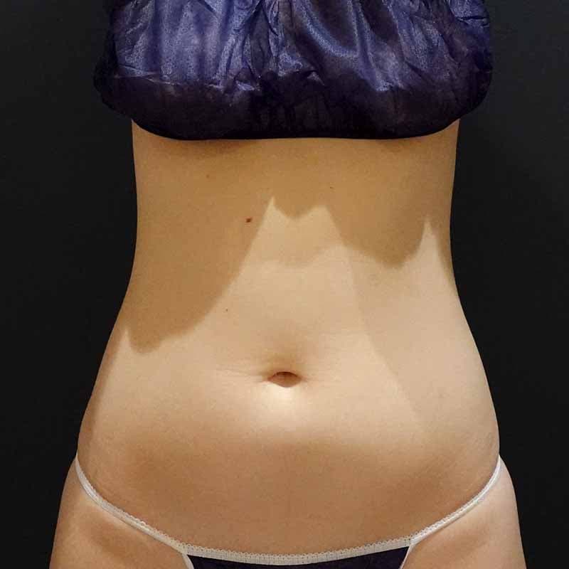 20260512_G107636_furumura_stomach-liposuction ①Before