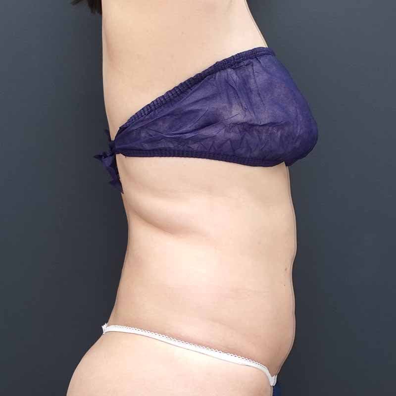 20260512_N103408_furumura_stomach-liposuction ③After