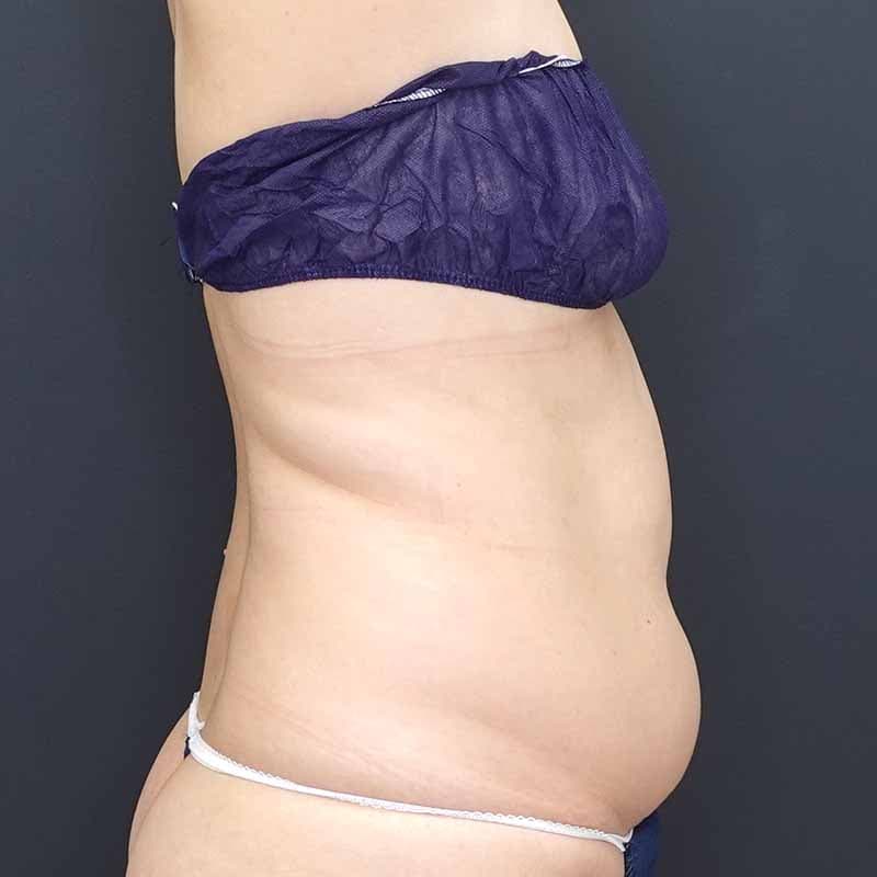 20260512_N103408_furumura_stomach-liposuction ③Before
