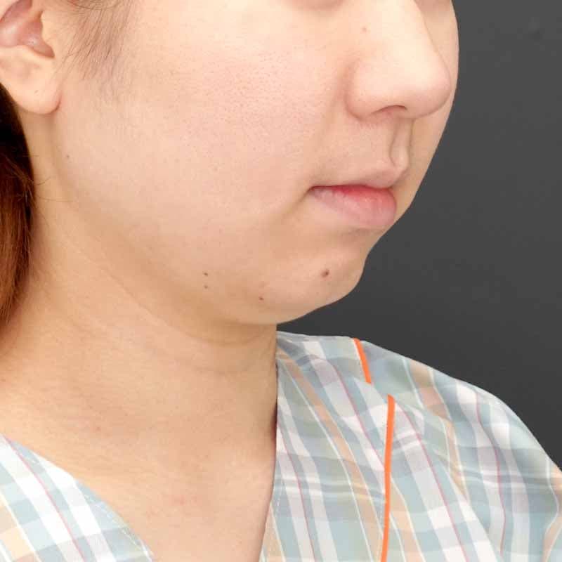 20260513_N49743_nishikawa_face-liposuction ①Before