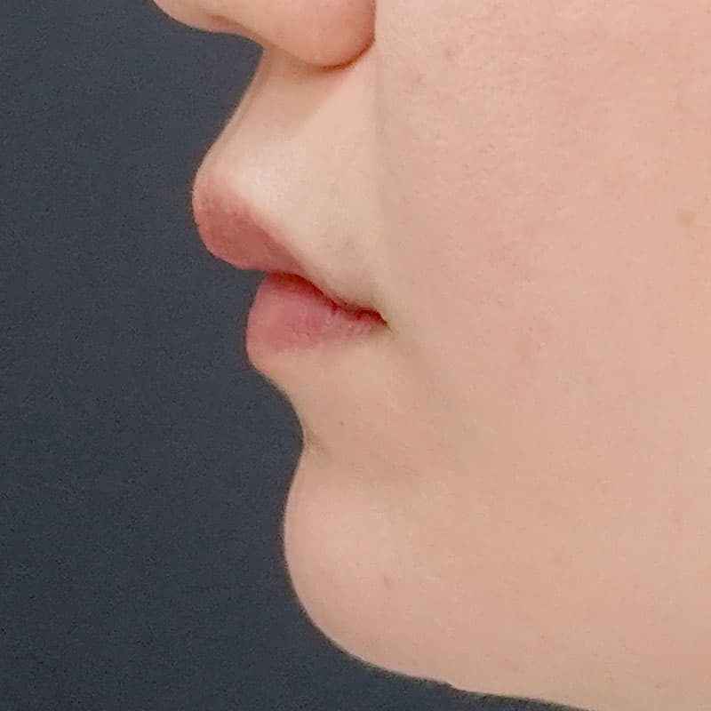 20260514_N37169_sugishima_hyaluronic lips①After