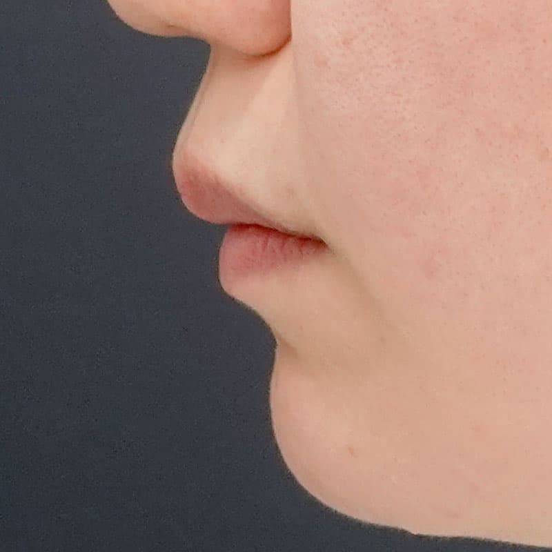 20260514_N37169_sugishima_hyaluronic lips①Before