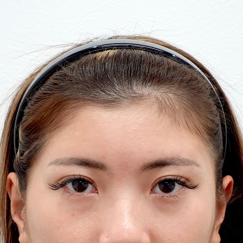 20260515_G118601_koito_hyaluronic forehead- temples①After