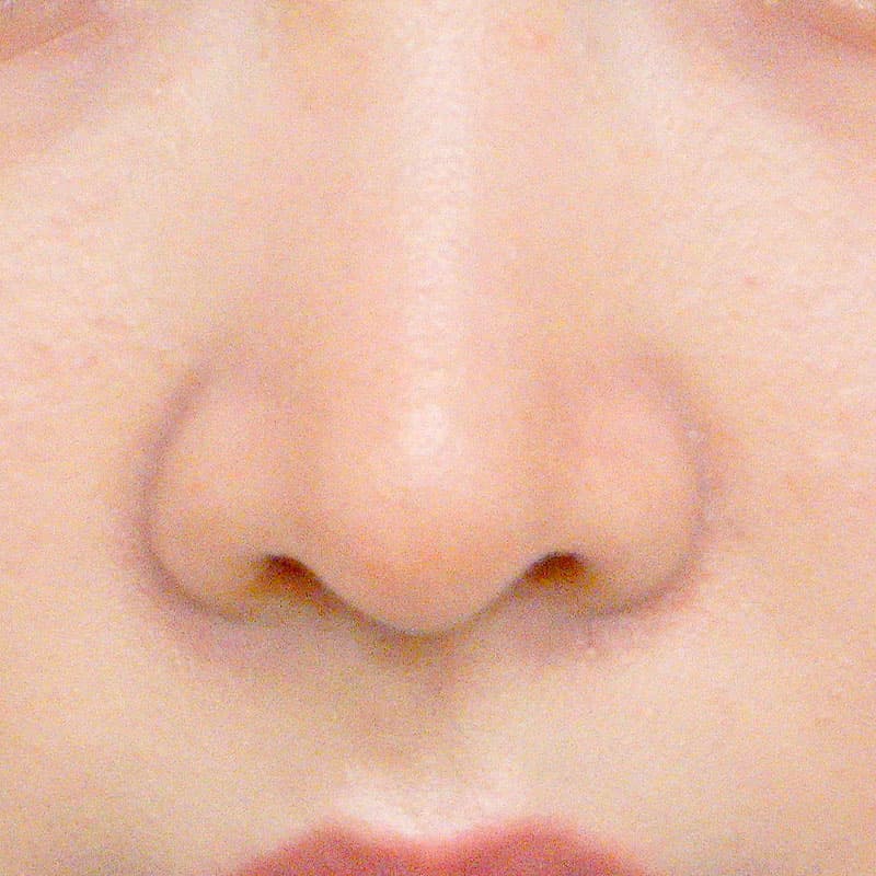 20260527_O19299_sato_nose tip reduction-auricular cartilage①After