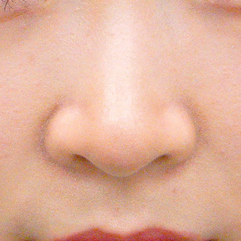 20260527_O19299_sato_nose tip reduction-auricular cartilage①Before