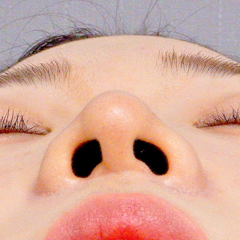 20260527_O19299_sato_nose tip reduction-auricular cartilage②After