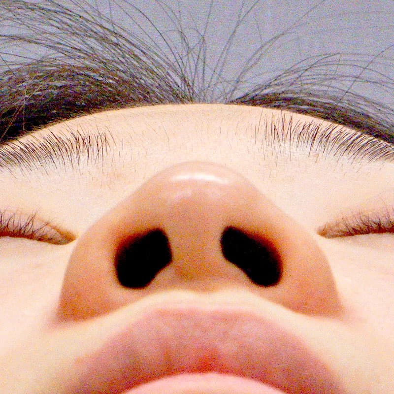 20260527_O19299_sato_nose tip reduction-auricular cartilage②Before