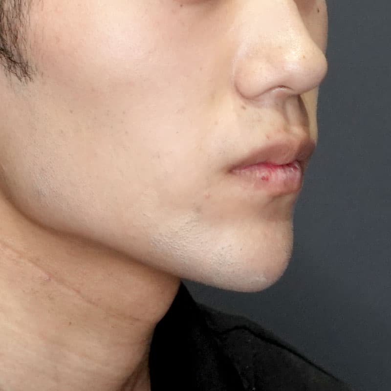 20260530_G30106_ishihara_chin prosthesis①After