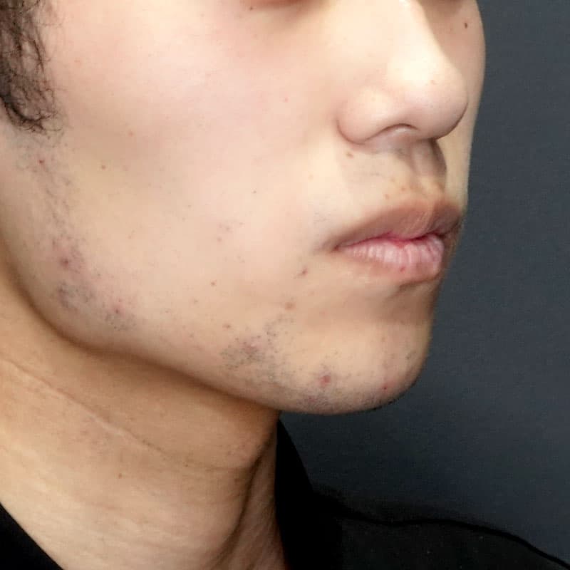 20260530_G30106_ishihara_chin prosthesis①Before