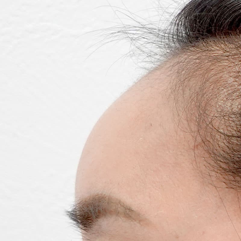 20260530_G35620_osada_hyaluronic forehead- temples①After