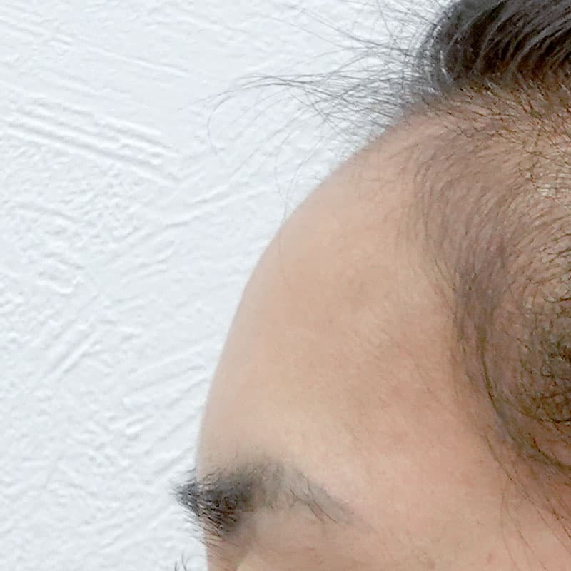 20260530_G35620_osada_hyaluronic forehead- temples①Before