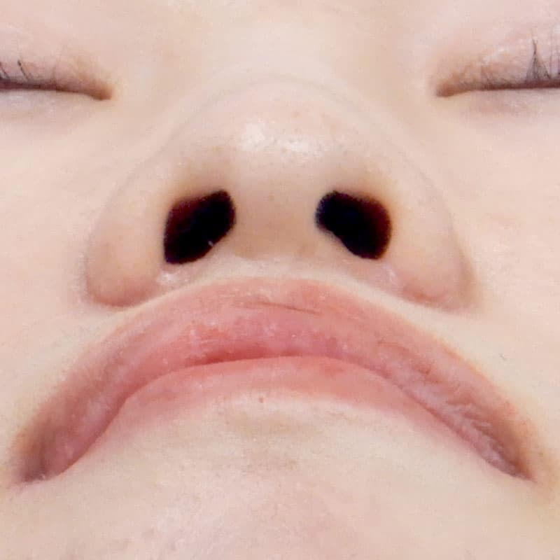 20260530_N22152_takemura_nostril reduction①After