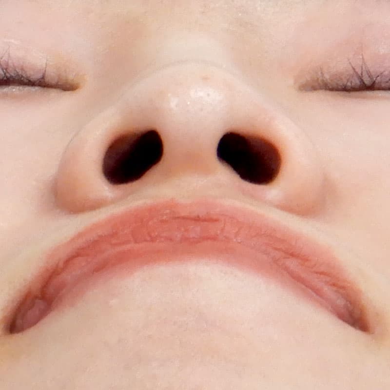 20260530_N22152_takemura_nostril reduction①Before