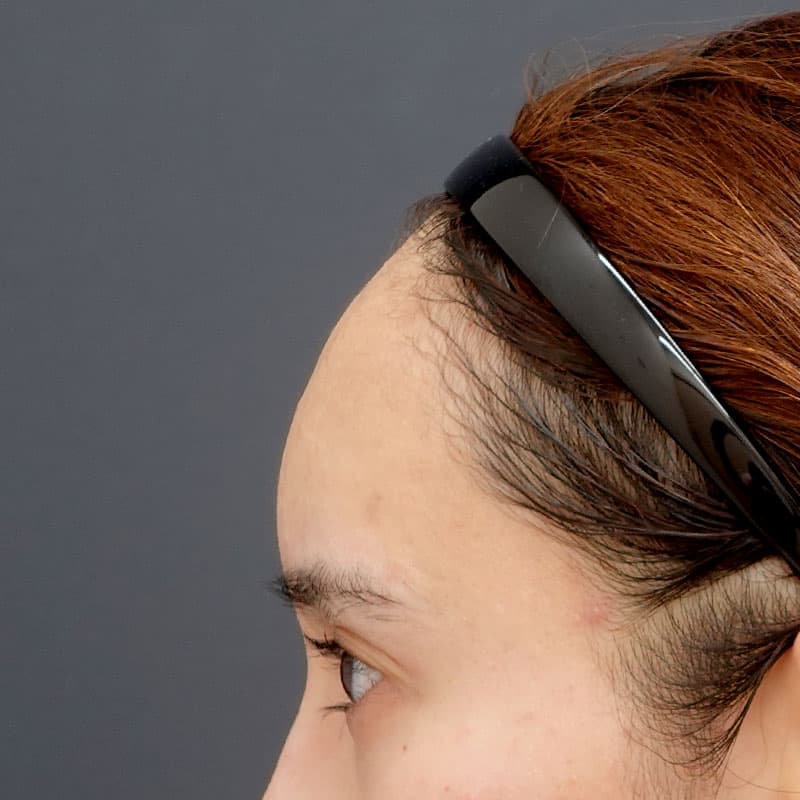 20260530_N29379_sugishima_hyaluronic forehead- temples①After