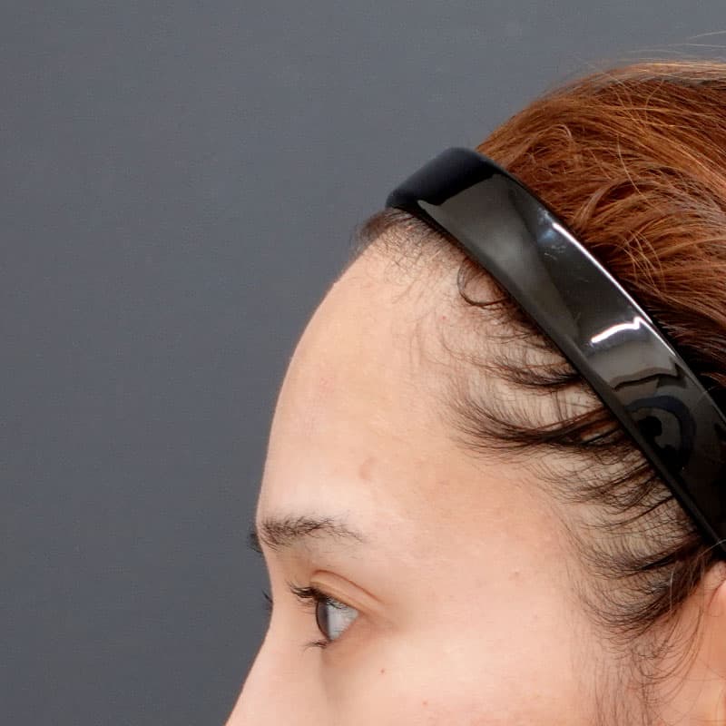 20260530_N29379_sugishima_hyaluronic forehead- temples①Before