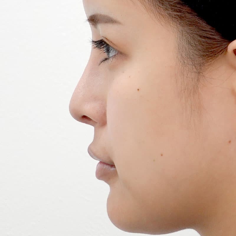 20260530_N36135_takemura_nose tip reduction-auricular cartilage①After