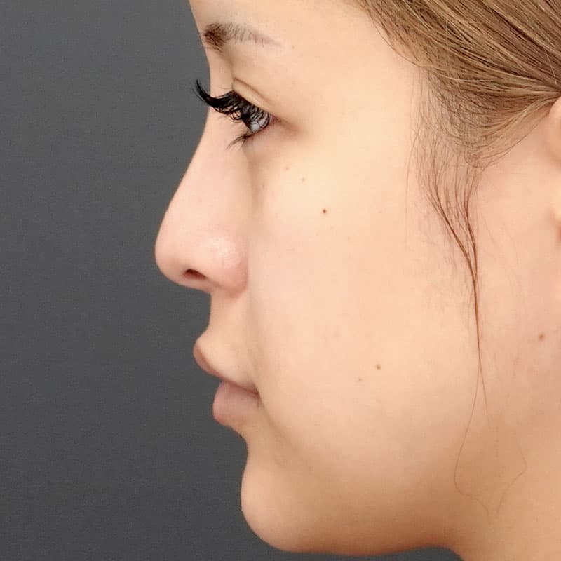 20260530_N36135_takemura_nose tip reduction-auricular cartilage①Before