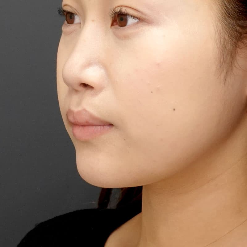 20260530_N39002_takemura_chin prosthesis①After