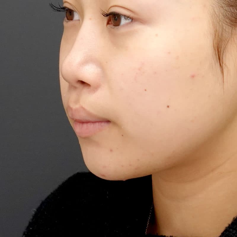 20260530_N39002_takemura_chin prosthesis①Before