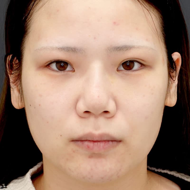 20260530_N39993_takemura_nose-prosthesis①After