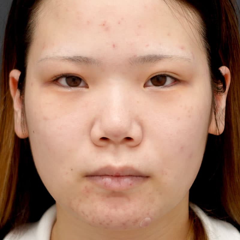 20260530_N39993_takemura_nose-prosthesis①Before