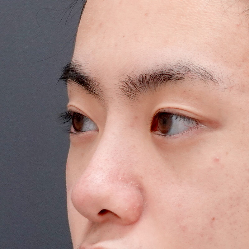 20260530_N50587_sugishima_hyaluronic nose①After
