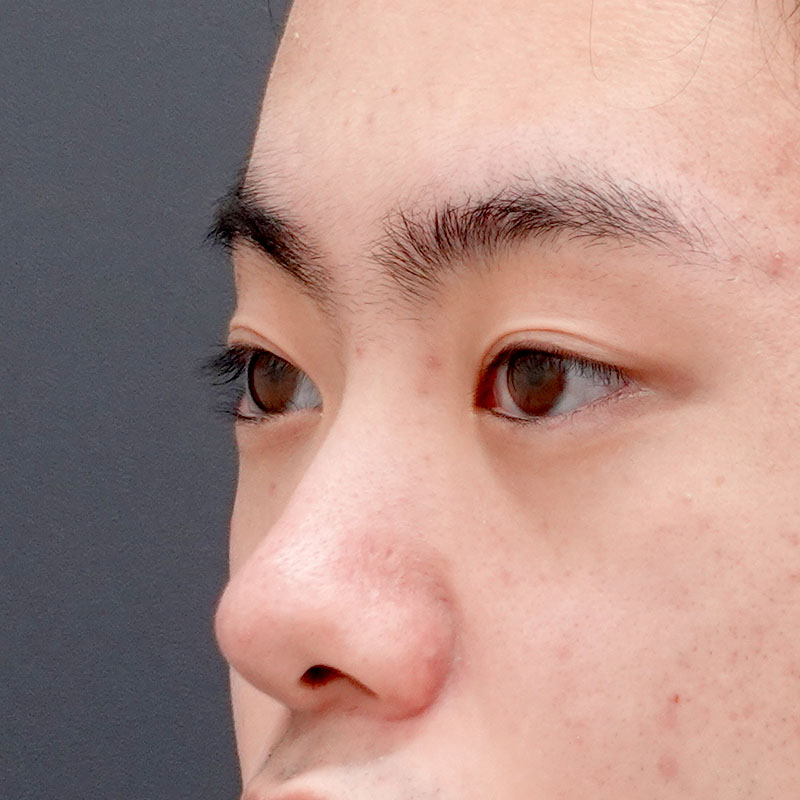 20260530_N50587_sugishima_hyaluronic nose①Before