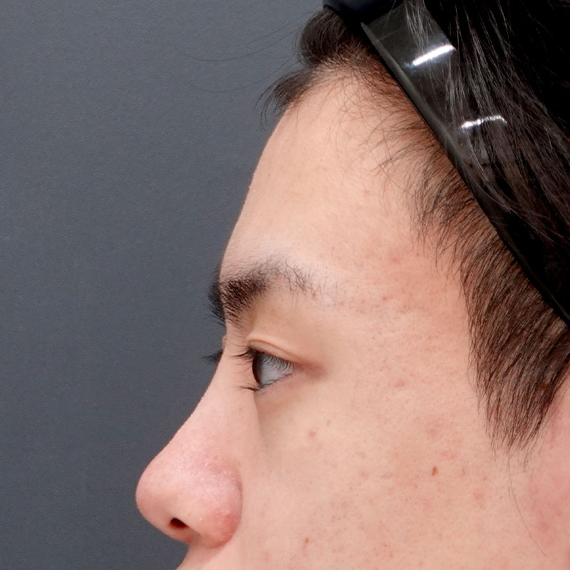 20260530_N50587_sugishima_hyaluronic nose②After