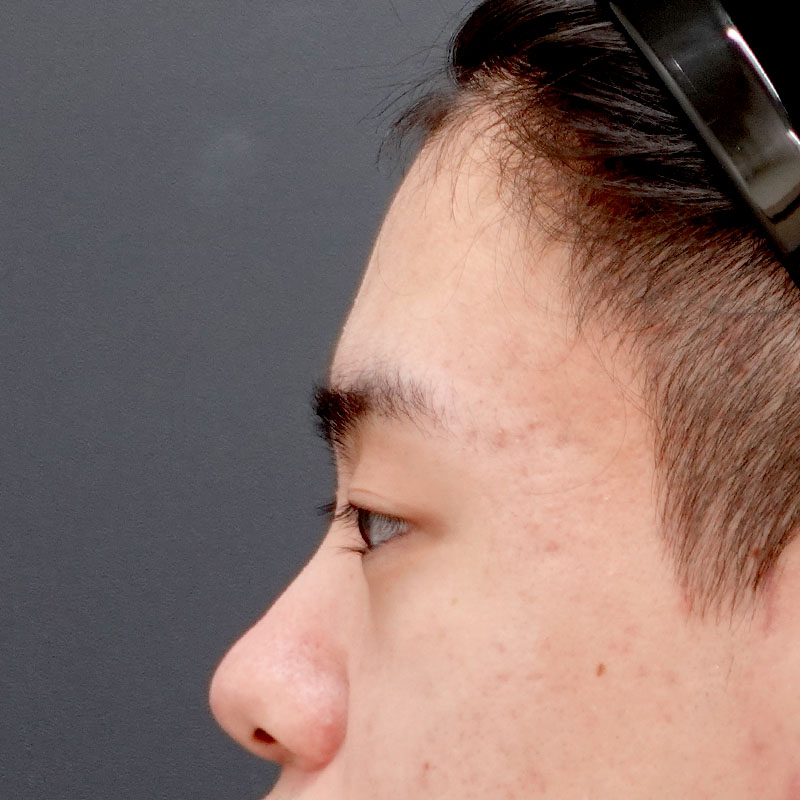20260530_N50587_sugishima_hyaluronic nose②Before