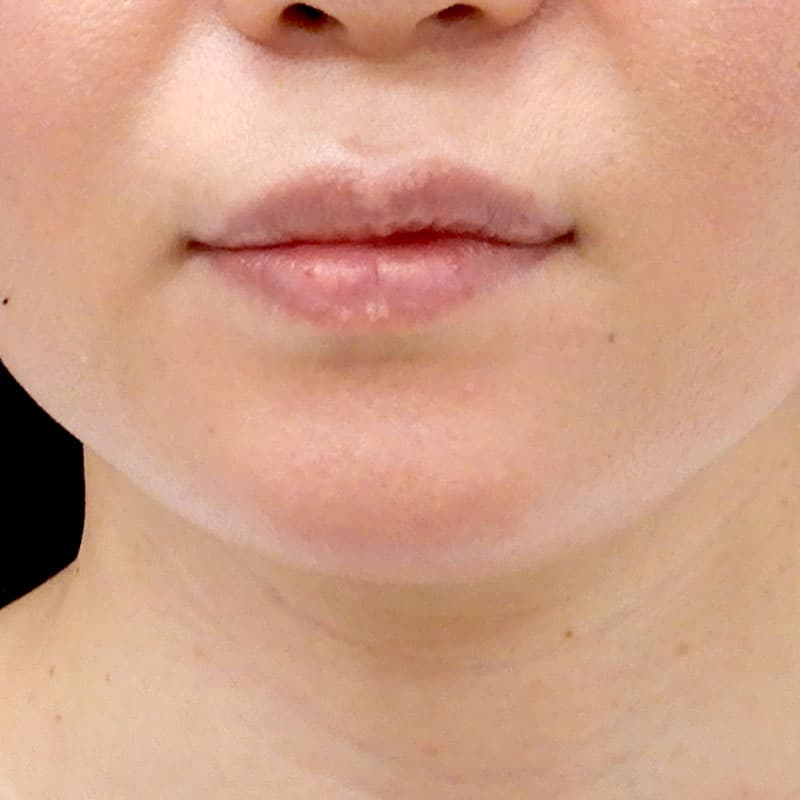 20260530_O20048_sato_chin prosthesis①After