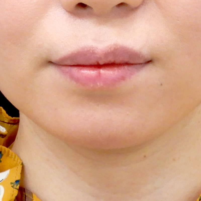 20260530_O20048_sato_chin prosthesis①Before