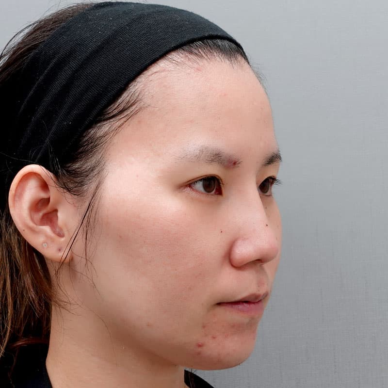 20260530_O27484_takemura_nose-prosthesis①After