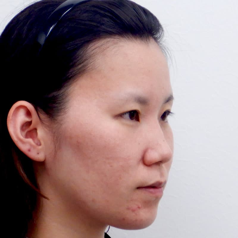 20260530_O27484_takemura_nose-prosthesis①Before
